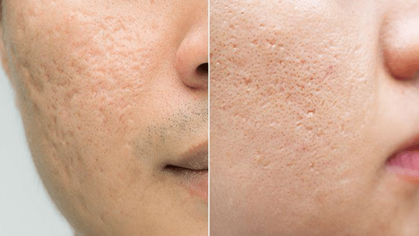 How To Get Rid Of Acne Scars – Happy LifeStyle Trends